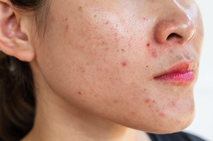 Asian woman with facial inflammatory acne