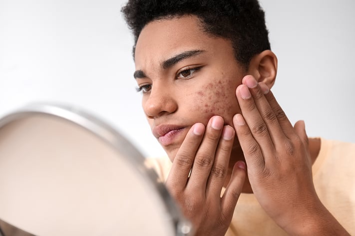 Man with darker skin looks at acne in mirror