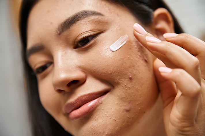 Ethnic woman applies facial cream for inflammatory acne