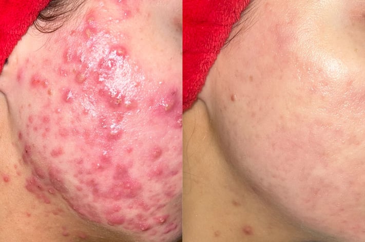 Acne Before & After photos from GlyMed Plus
