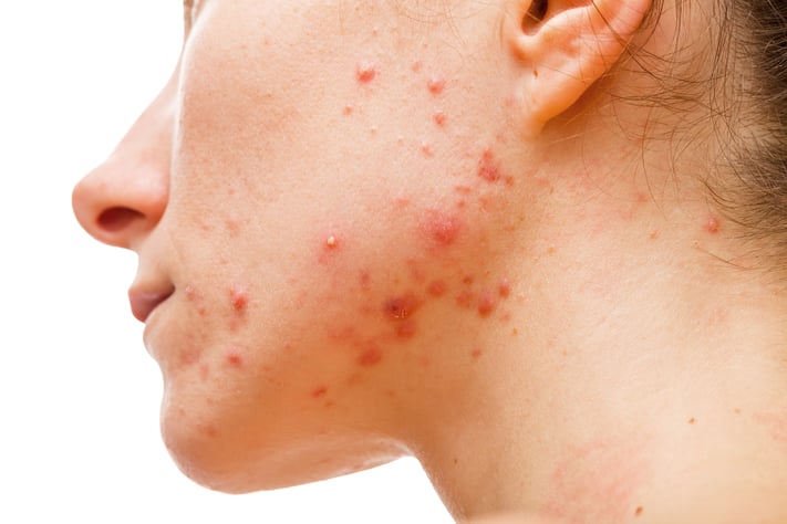 Woman with inflammatory acne or jawline acne on face