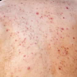 Post Inflammatory Erythema on the back.