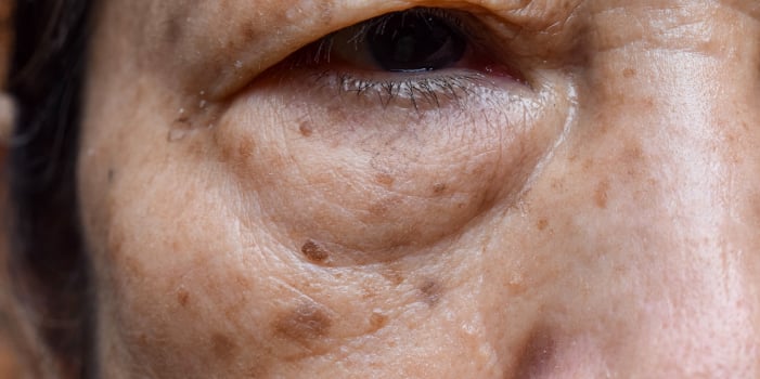 Older woman with age spots on her face.