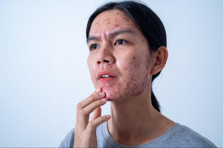 girl with cystic acne touching her face