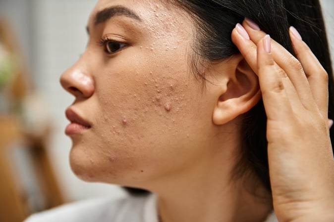 woman looking at acne in the mirror