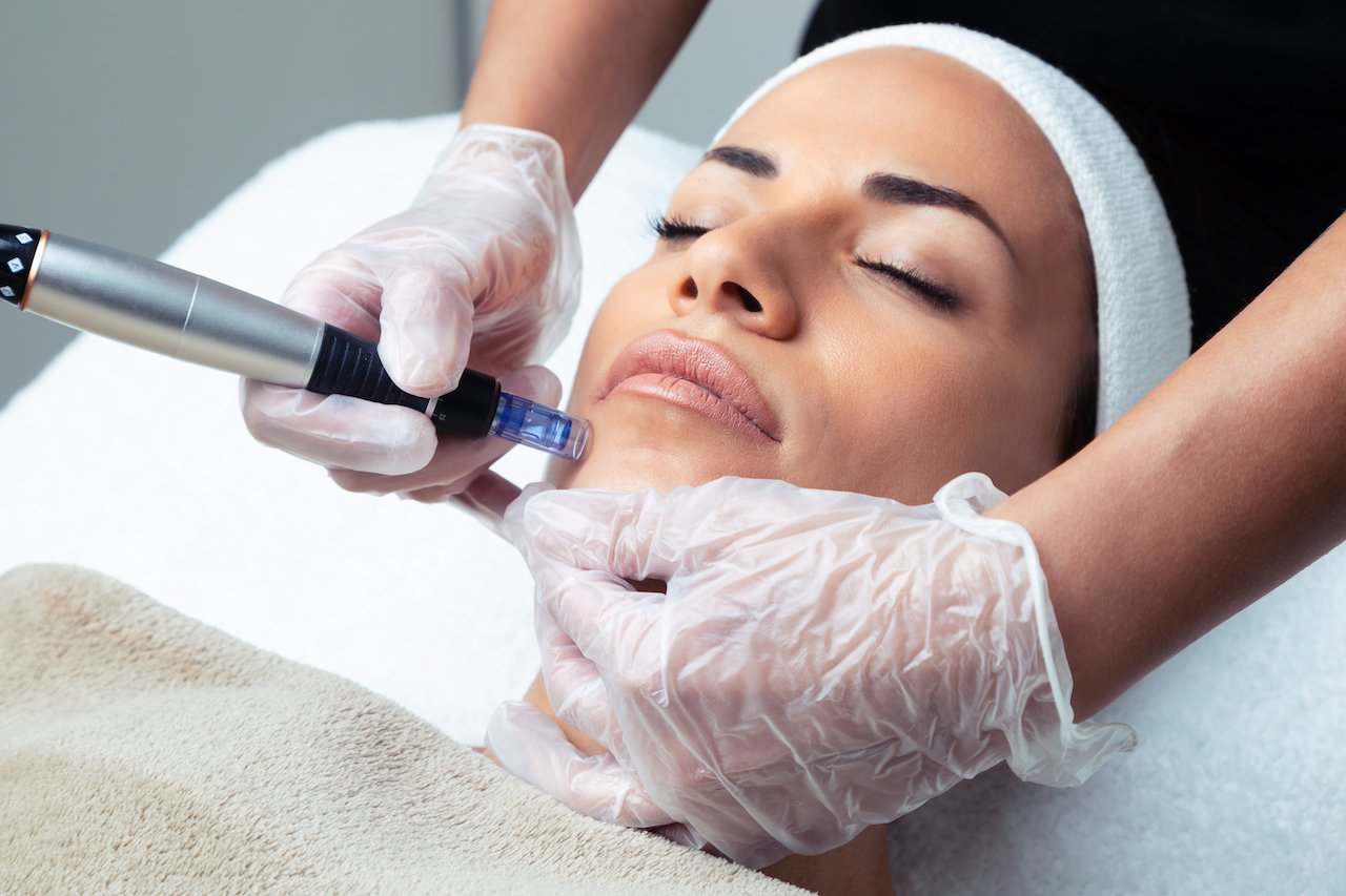 woman receiving microneedling treatment to help reduce adult acne scars