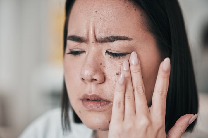 Woman experiencing pain from nodular acne