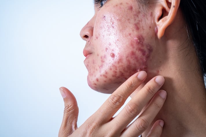 woman with inflammatory acne