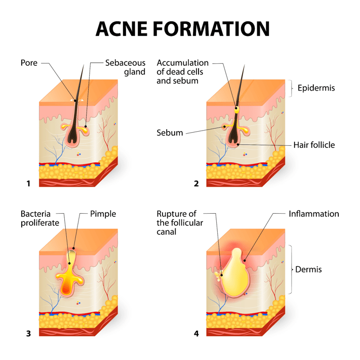A graphic showing acne formation in four stages