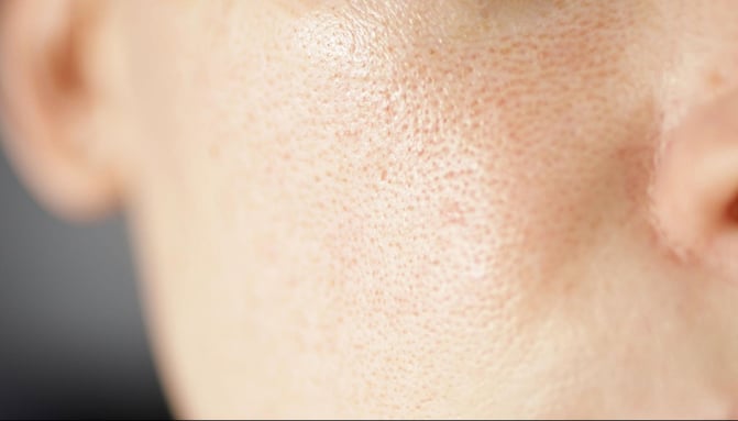 close-up of skin with enlarged pores and uneven texture