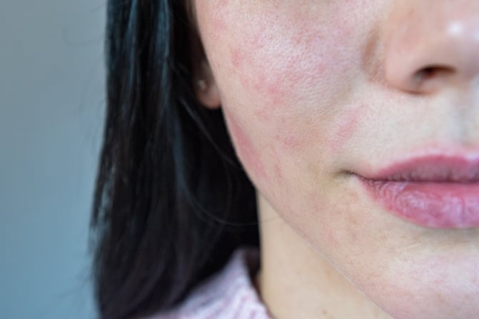 close up of facial redness and sensitive skin associated with rosacea flare-ups